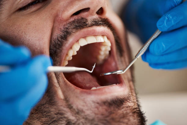 Best Emergency Tooth Extraction in Poydras, LA